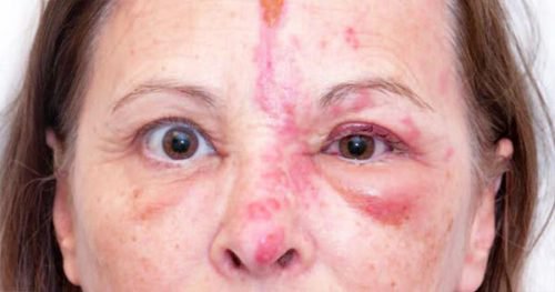 treatment-of-shingles-in-eyes-shingles-expert