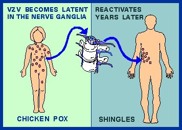 Chickenpox varicella reactivation