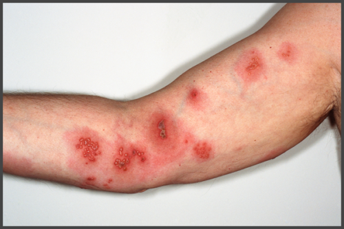 Pictures Of Shingles On Arm Shingles Expert 