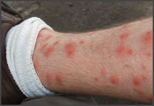 Does Shingles Cause Leg Pain