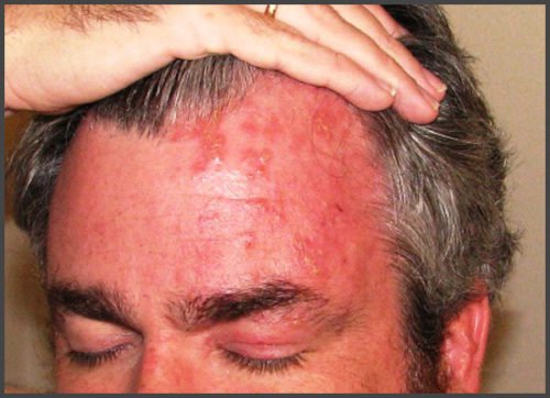 shingles-on-forehead-pictures-shingles-expert