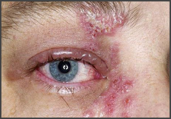 shingles-pictures-eye-shingles-expert